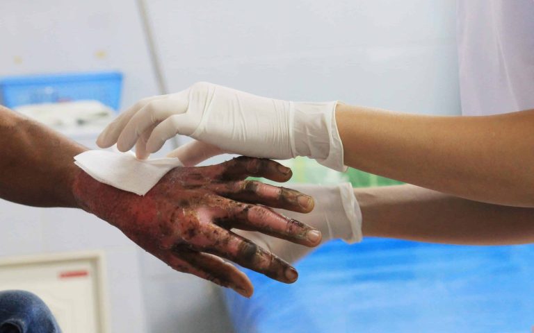 Treating Second-Degree Burns Better with Innovative Topical Antibiotics